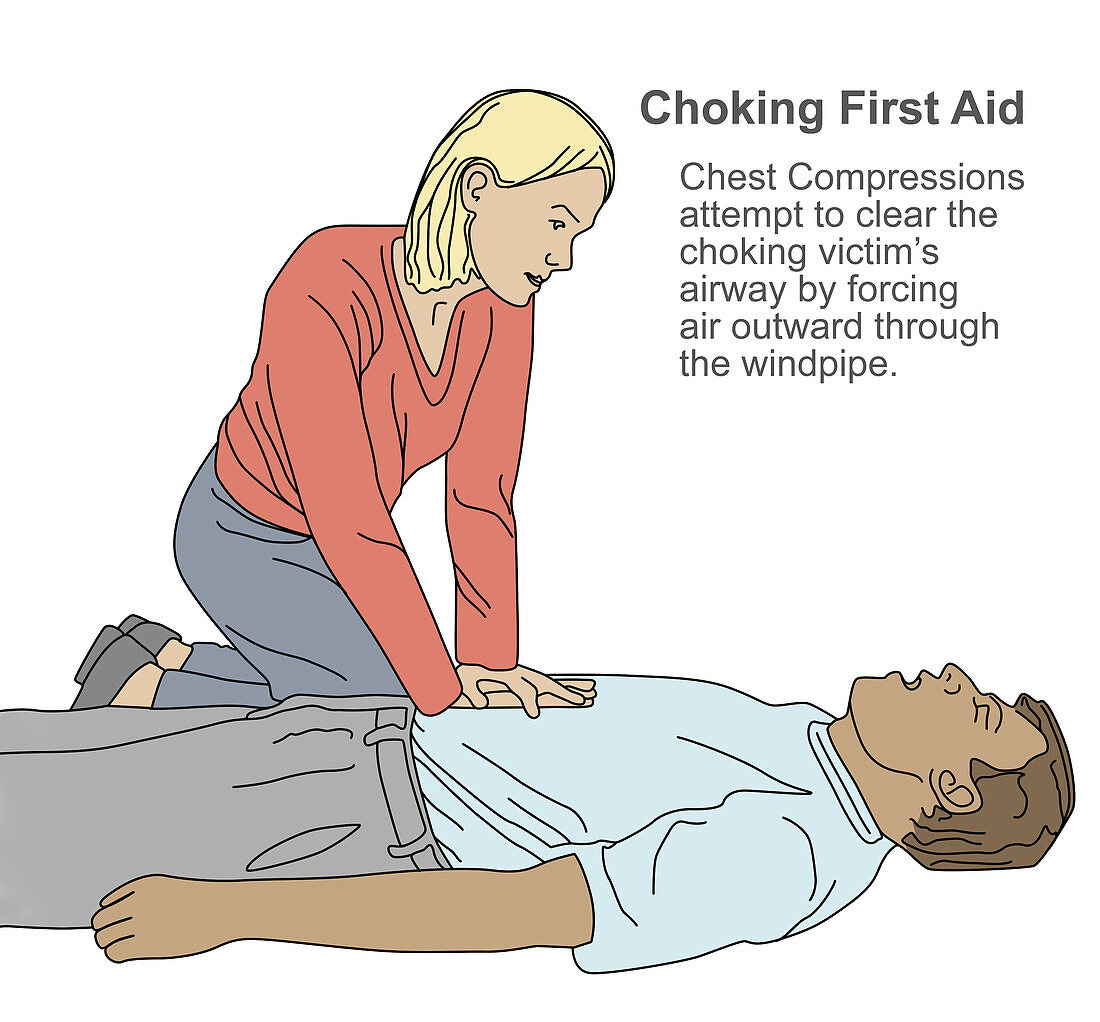 Choking First Aid,Illustration