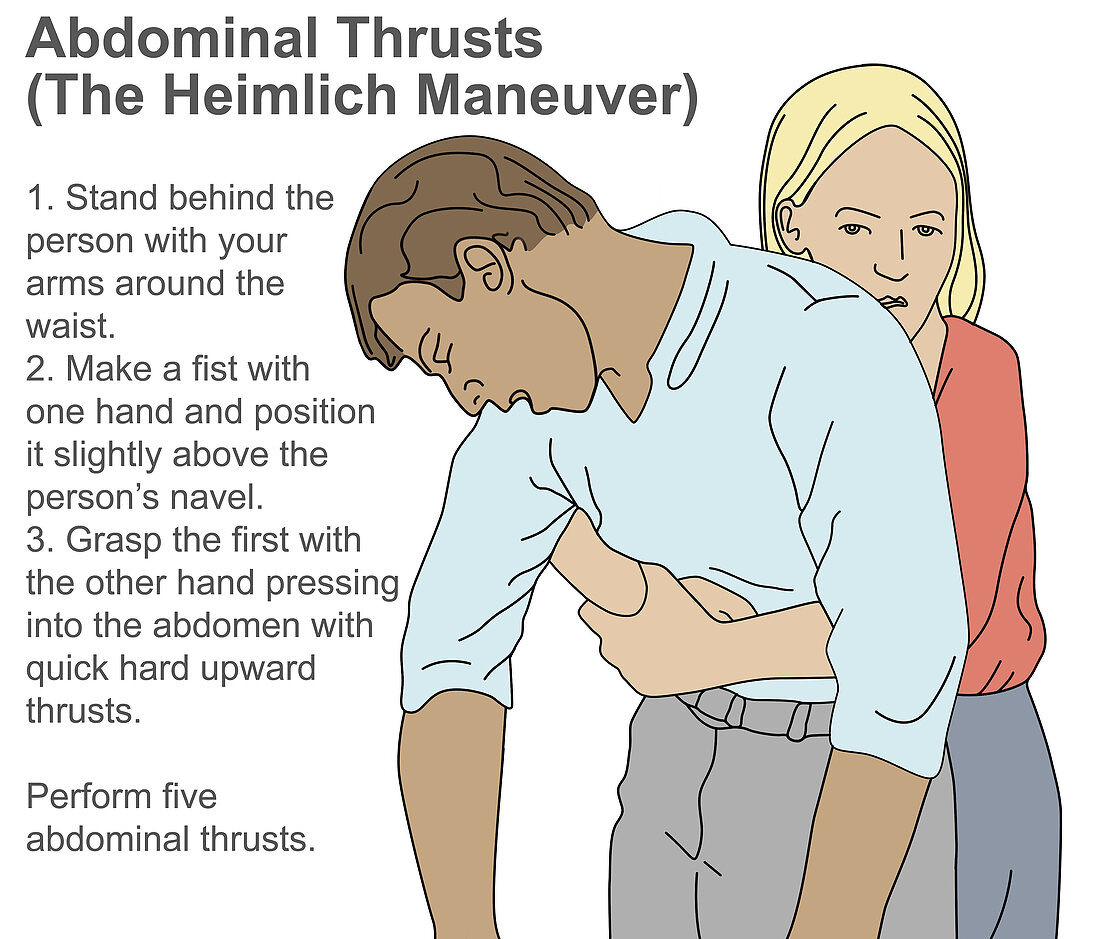 Heimlich Manoeuvre,Illustration