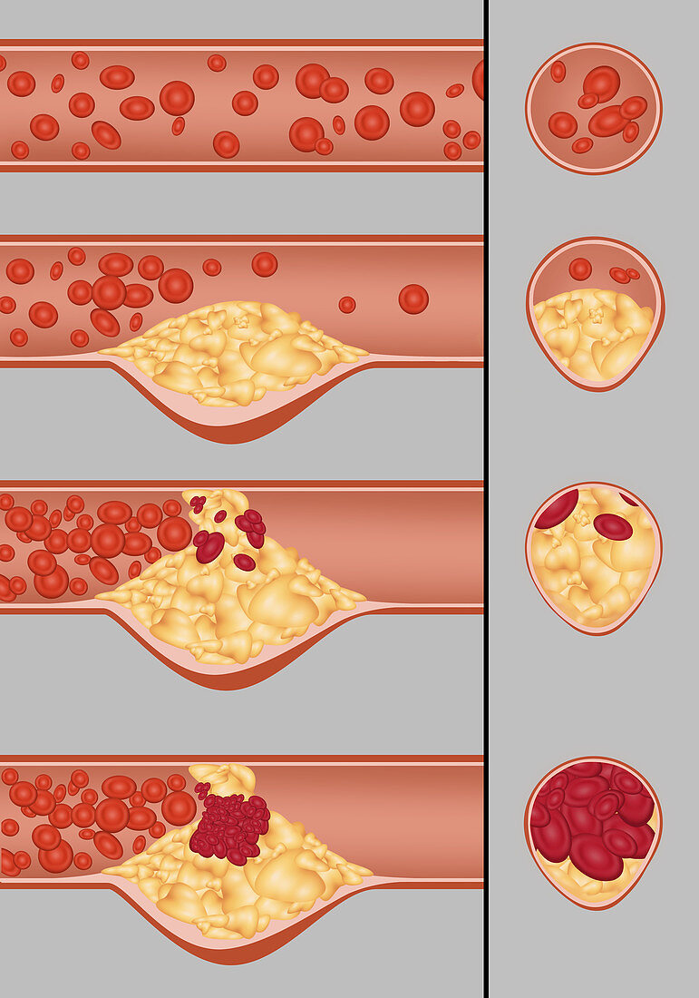 Plaque in Artery,Illustration