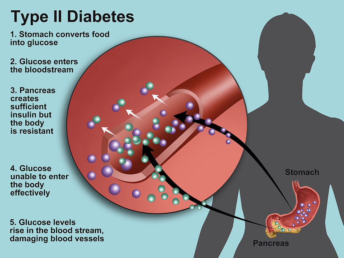 Type 2 Diabetes,Illustration