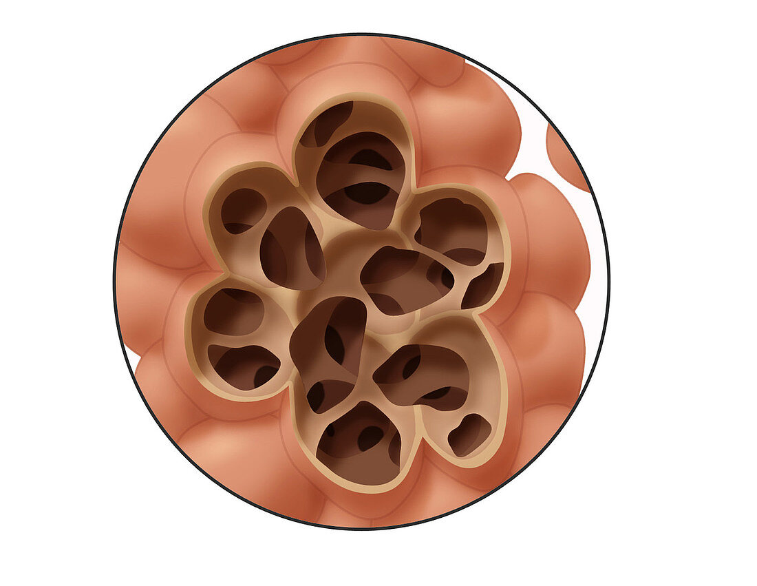 Damaged Alveoli,Illustration