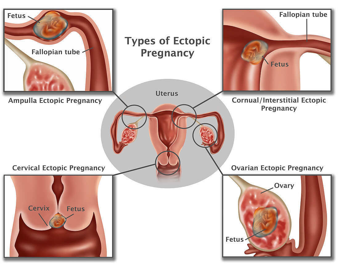 Ectopic Pregnancy,Illustration