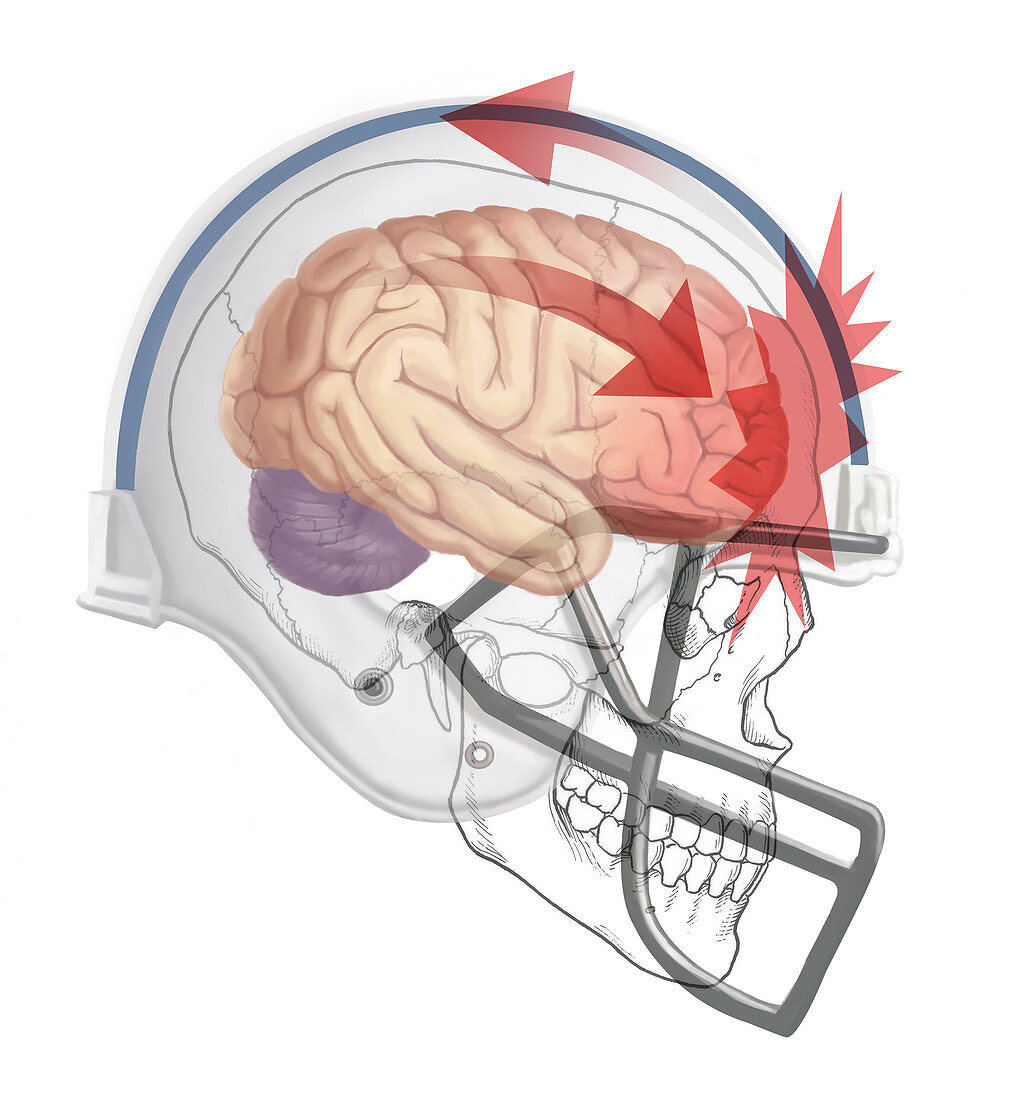 Concussion,Illustration