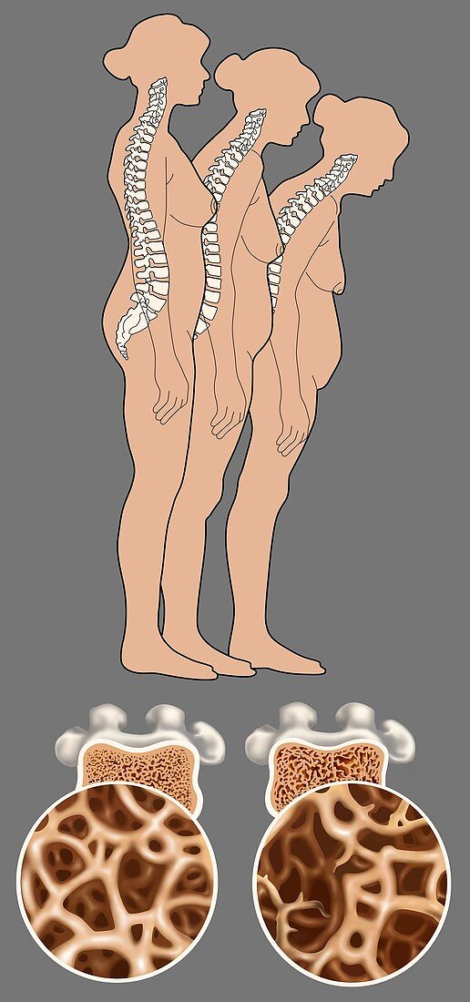 Osteoporosis,Illustration