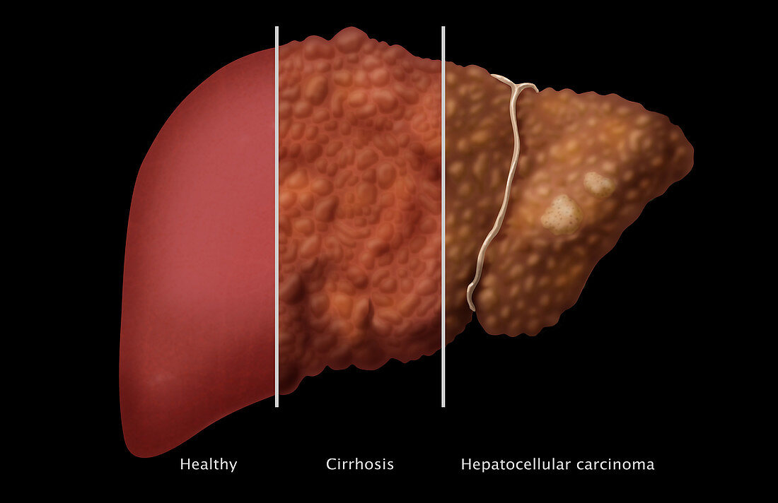 Liver Comparison,Illustration