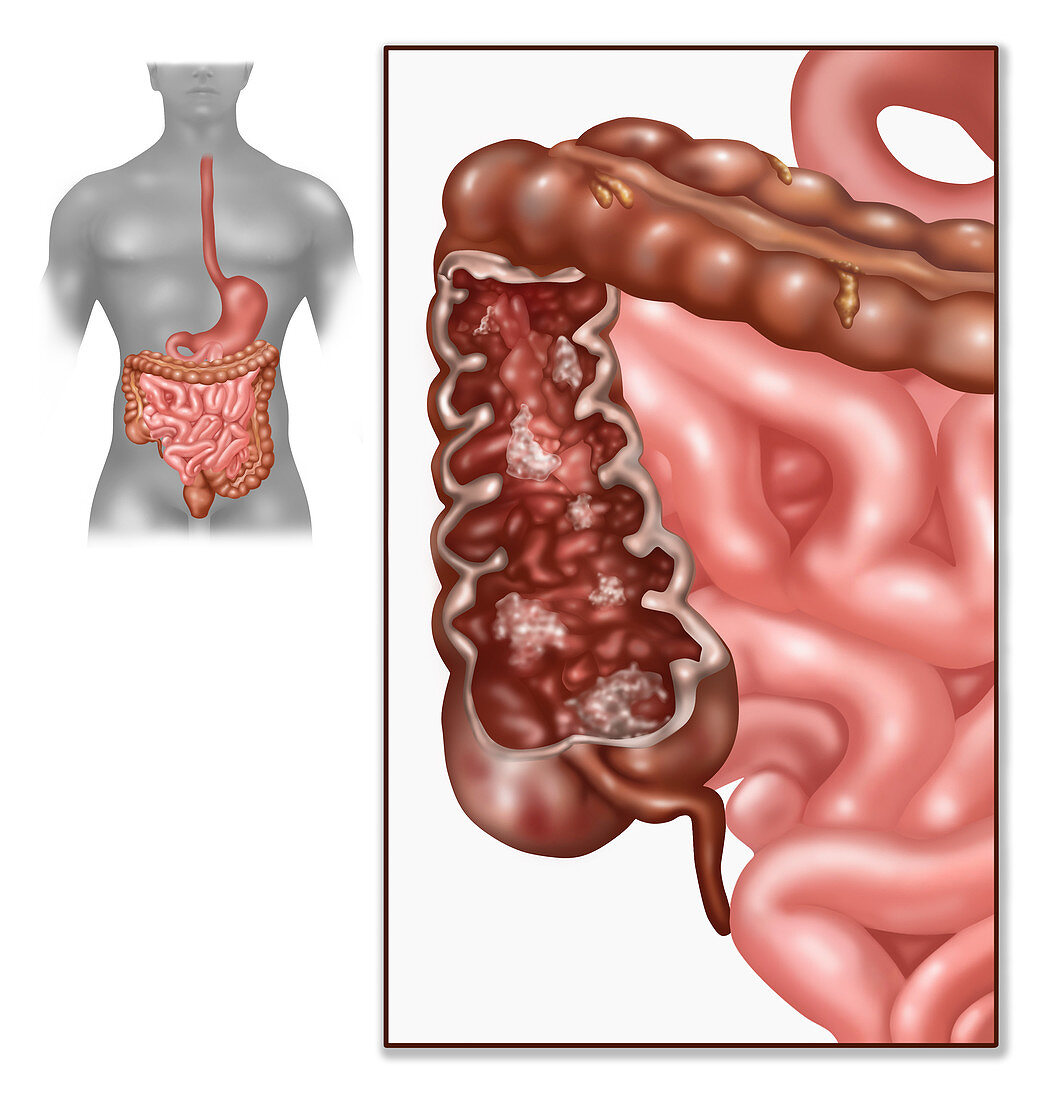 Crohn's Disease,IBD,Illustration
