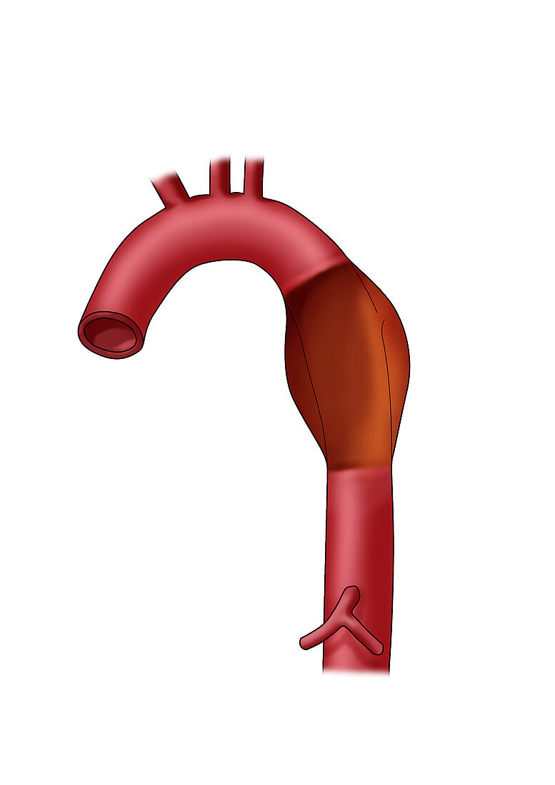 Aortic Dissection,Illustration