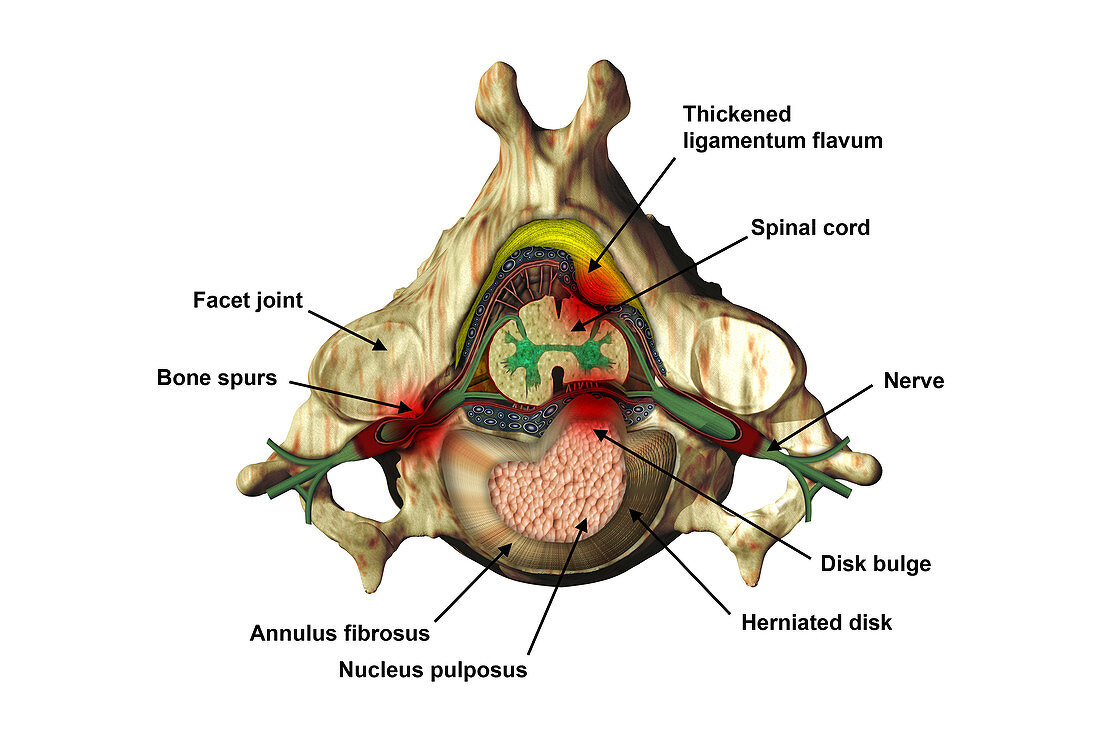Spinal Nerve Compression,Illustration
