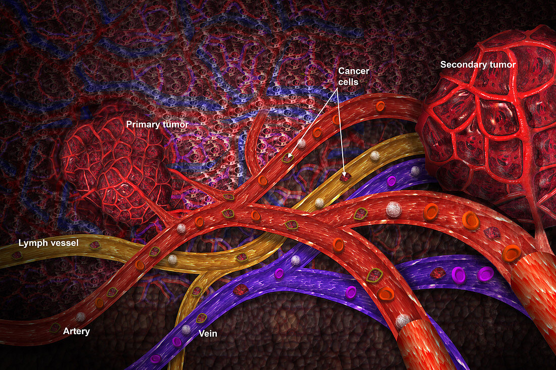 Metastasis,Illustration