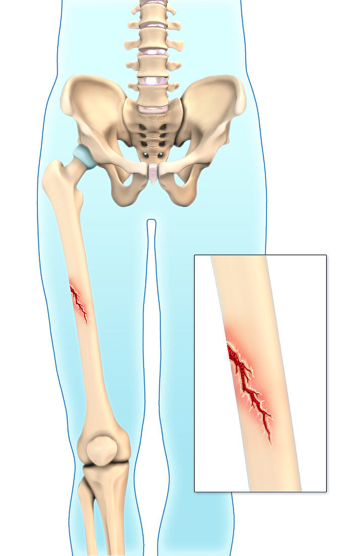 Greenstick Bone Fracture,Illustration