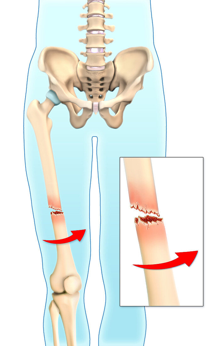 Spiral Bone Fracture,Illustration
