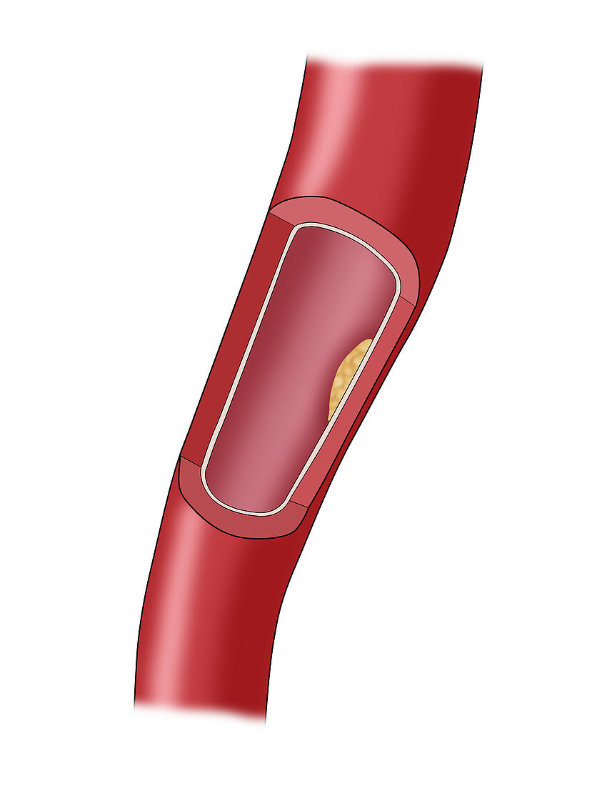Clogged Artery,2 of 4,Illustration