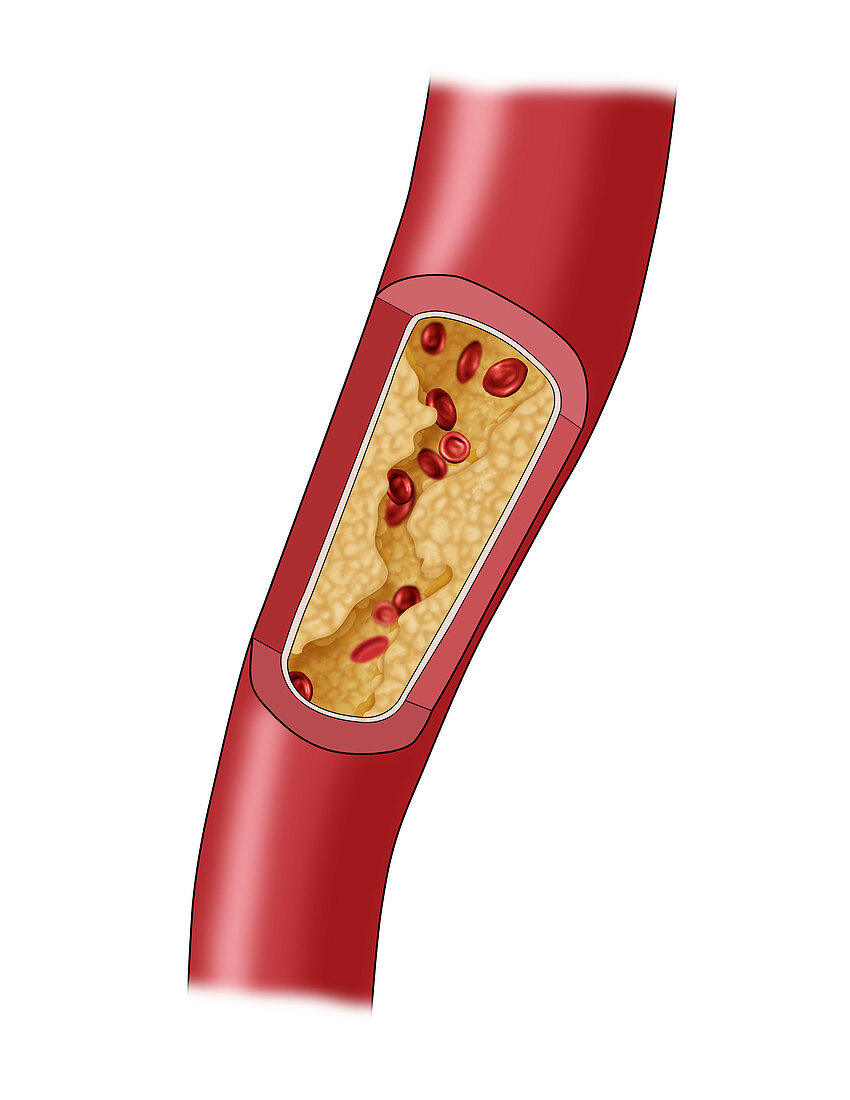 Clogged Artery,4 of 5,Illustration