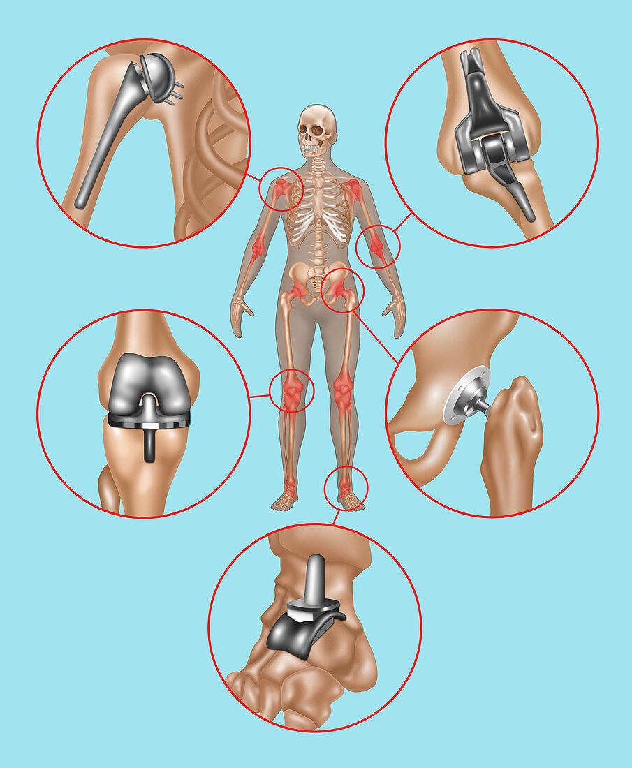 Joint Replacements,Illustration