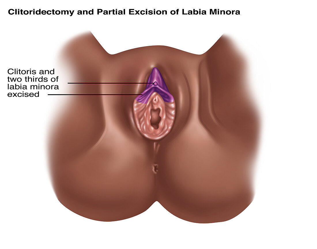 Clitoridectomy,Illustration
