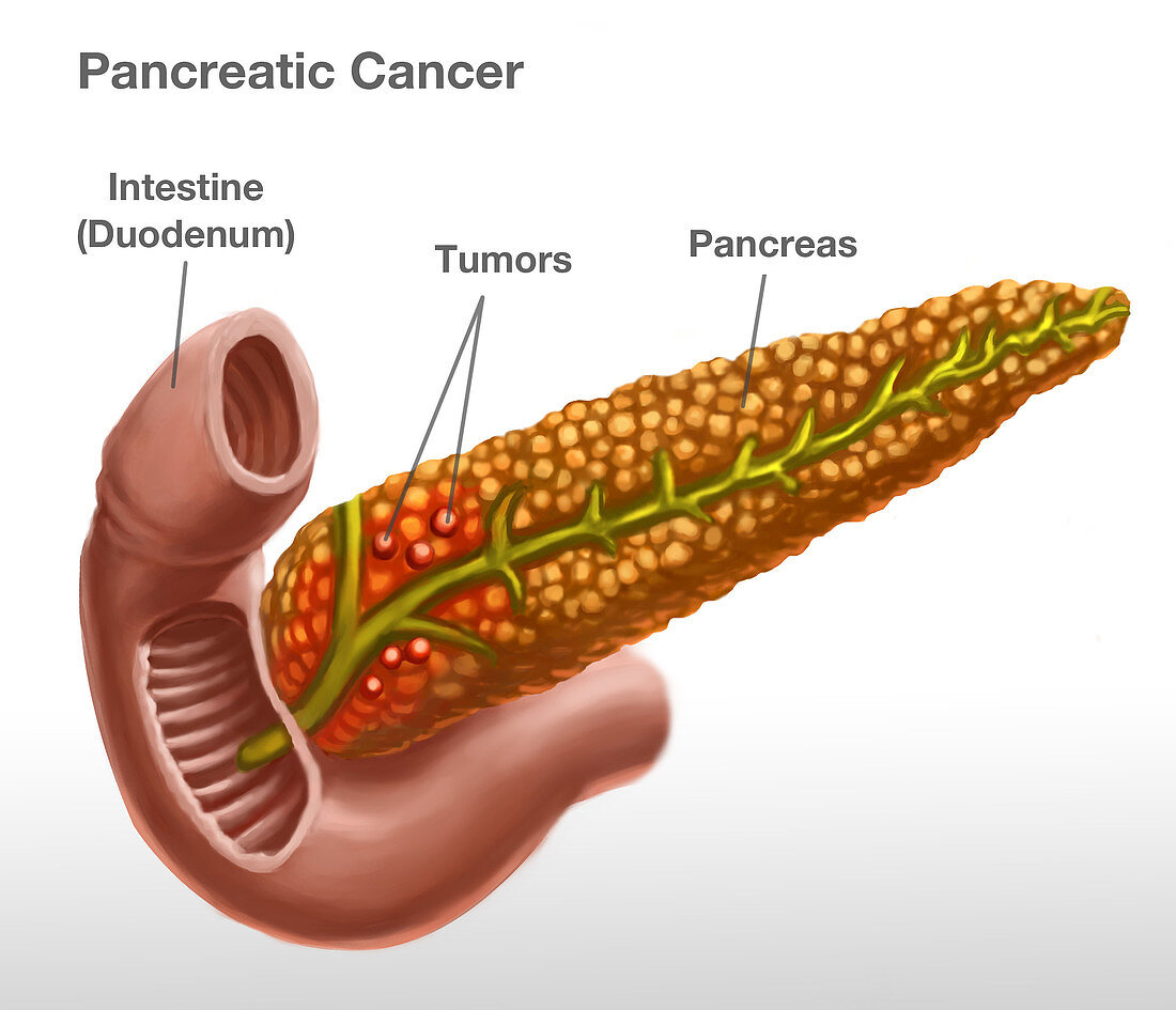 Pancreatic Cancer,Illustration