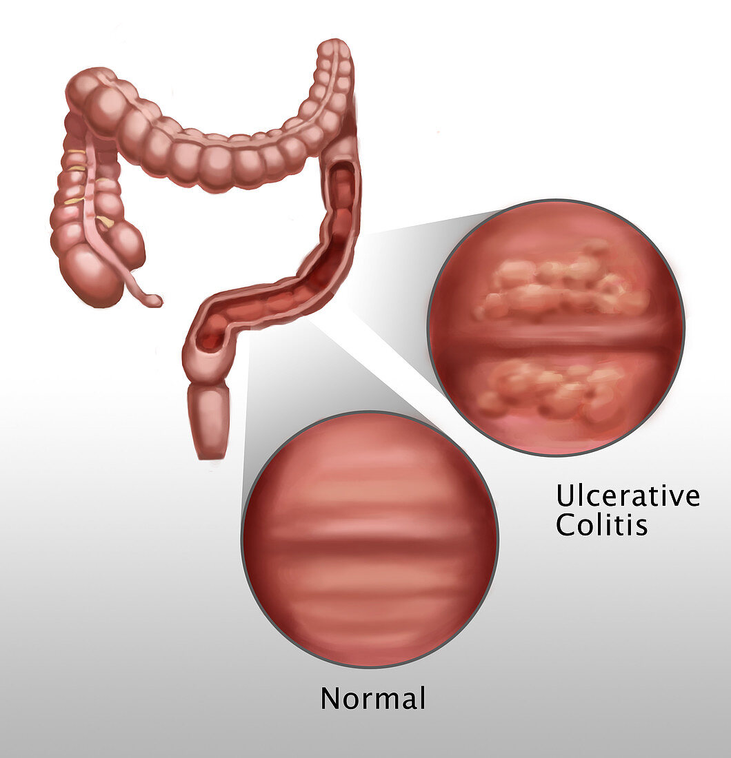 Ulcerative Colitis,Illustration