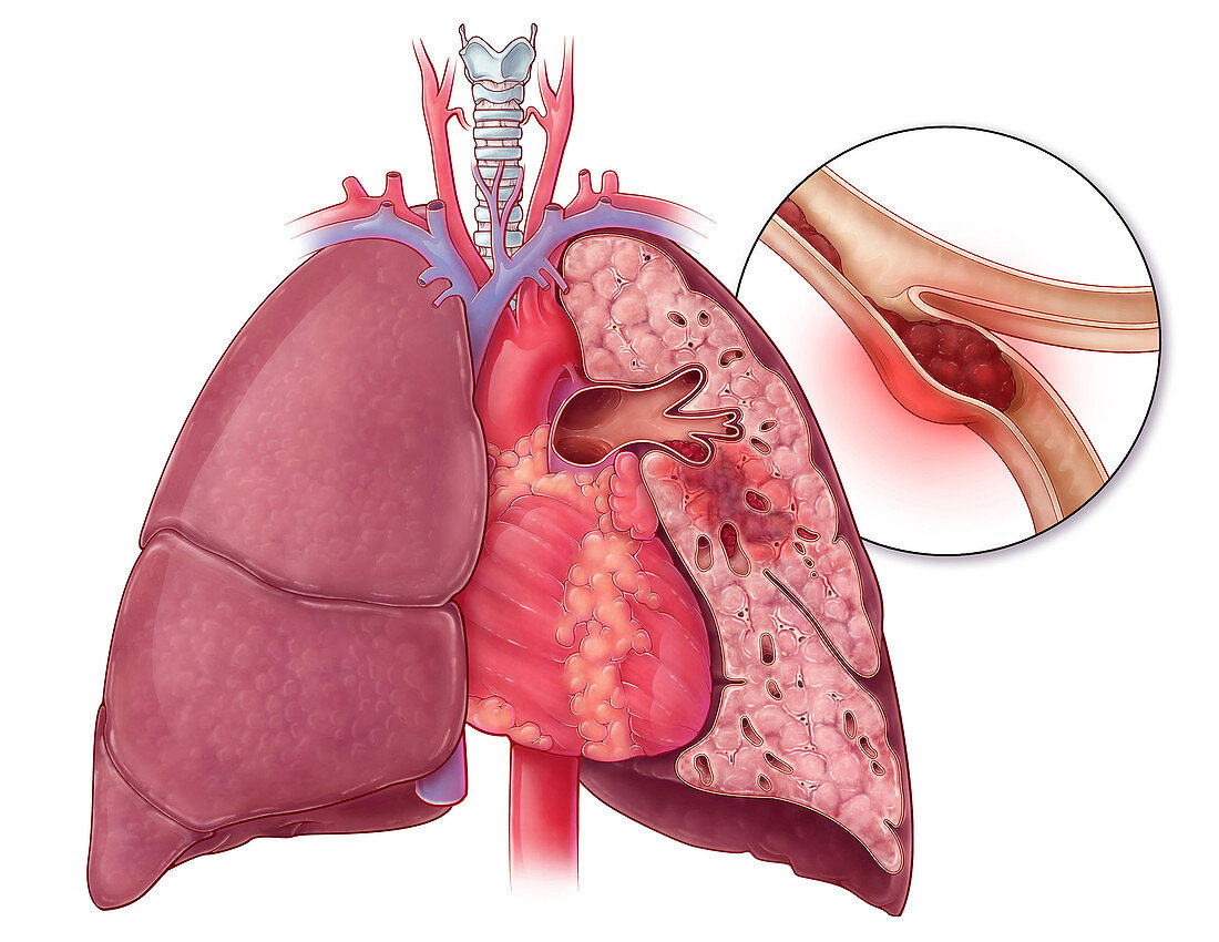 Pulmonary Embolism,Illustration