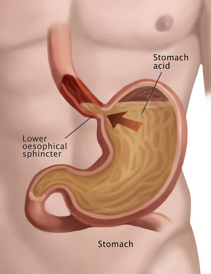 Stomach Acid Reflux,Illustration