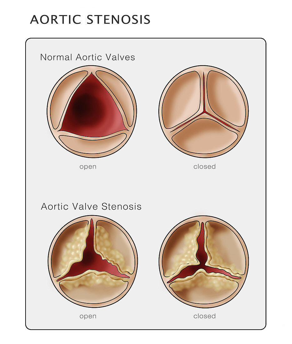 Aortic Valve,Illustration
