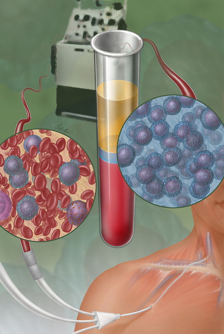 Stem Cell Transplantation,Illustration