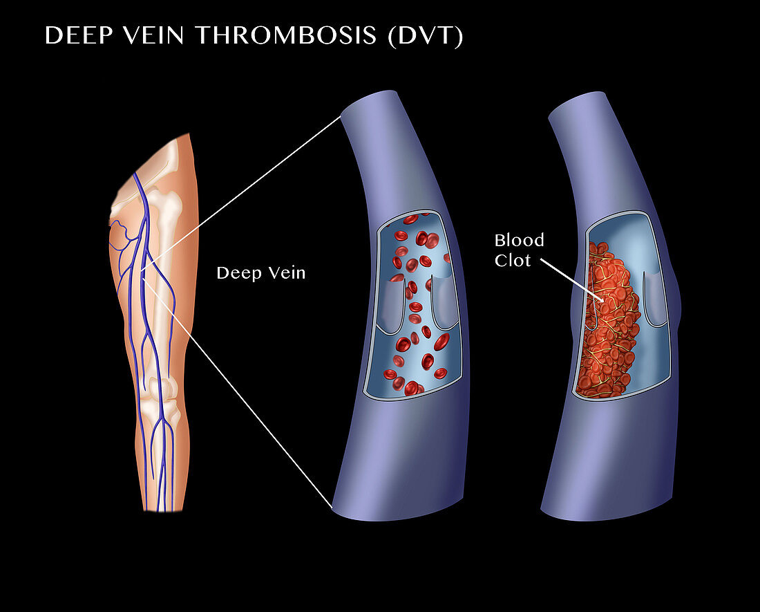 Deep Vein Thrombosis,Illustration