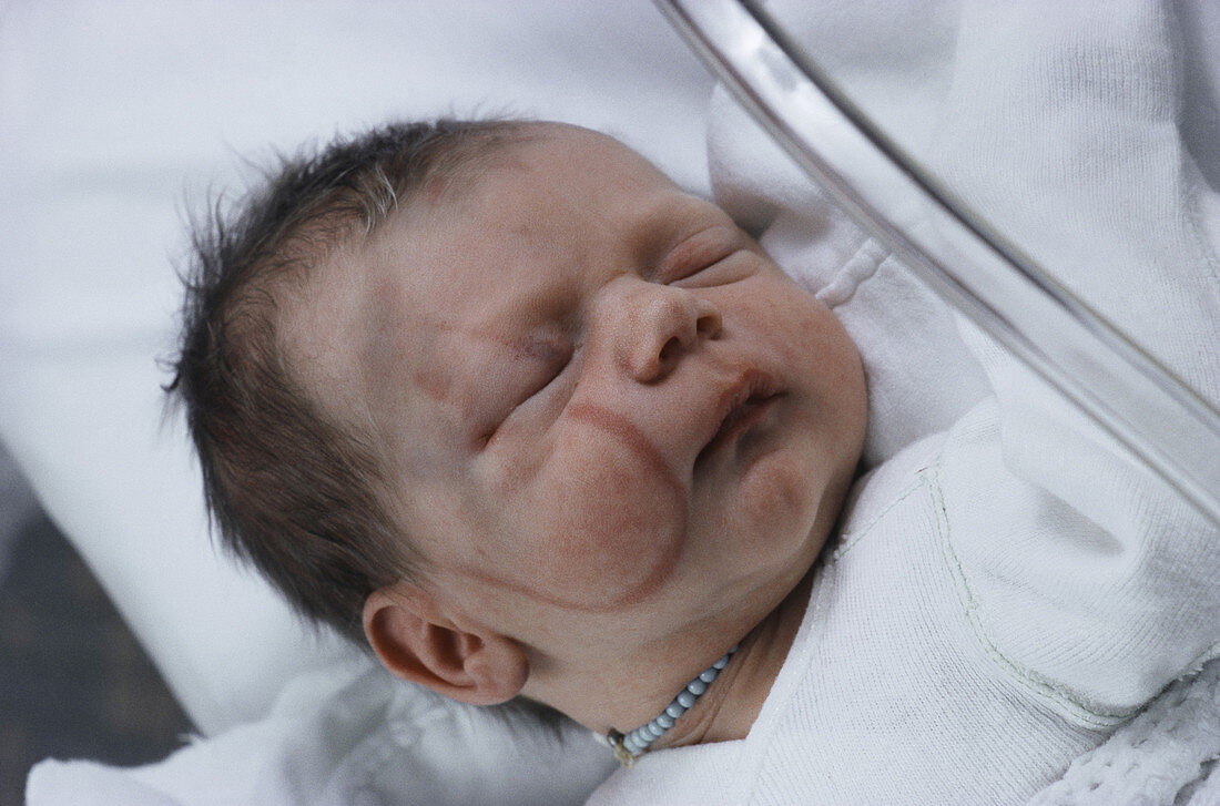 Forceps Mark on Face,Newborn Baby