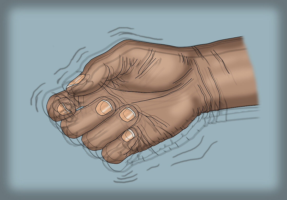 Hand Tremor,Illustration
