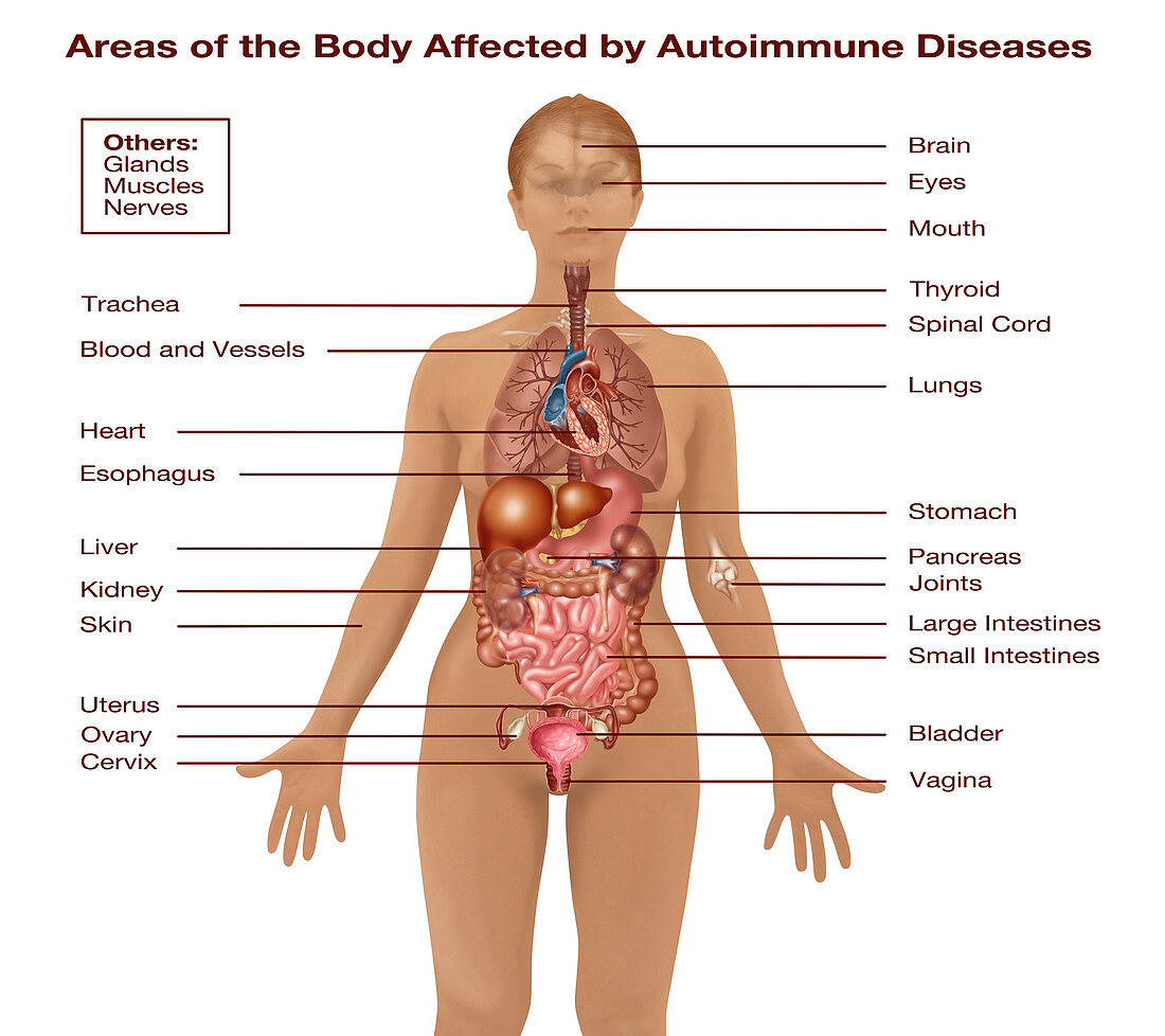 Autoimmune Disease,Illustration