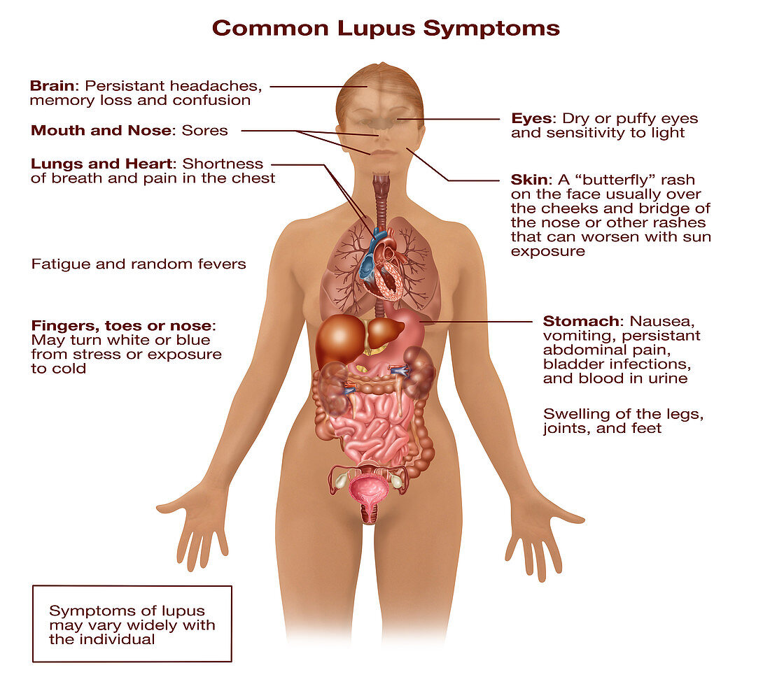 Common Lupus Symptoms,Illustration