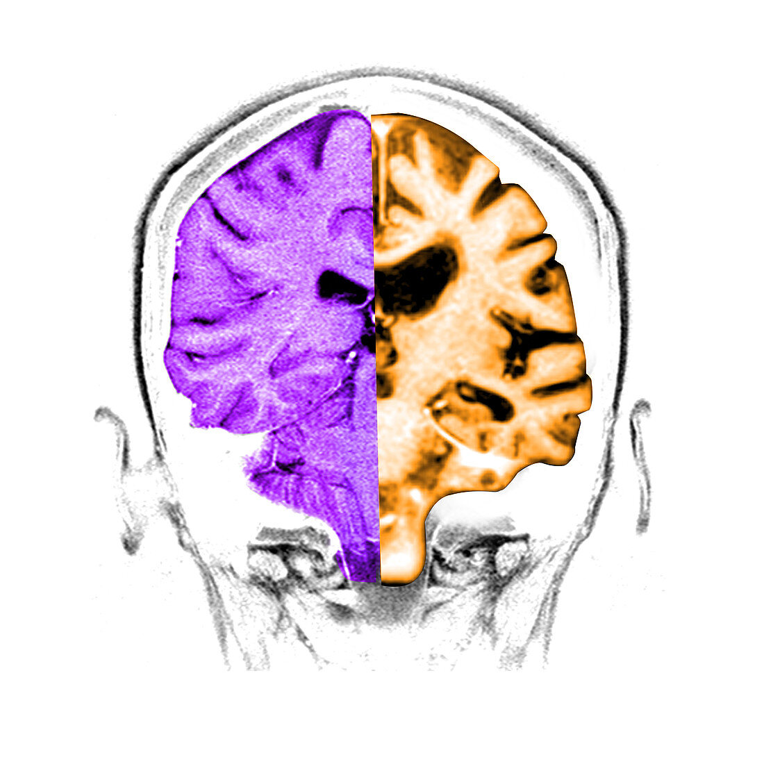 Normal Alzheimer's Brain Comparison