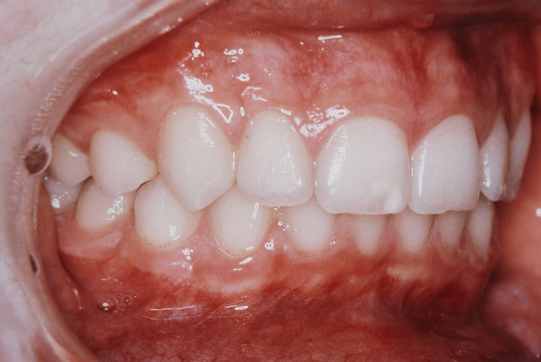 Premolars showing interdigitation