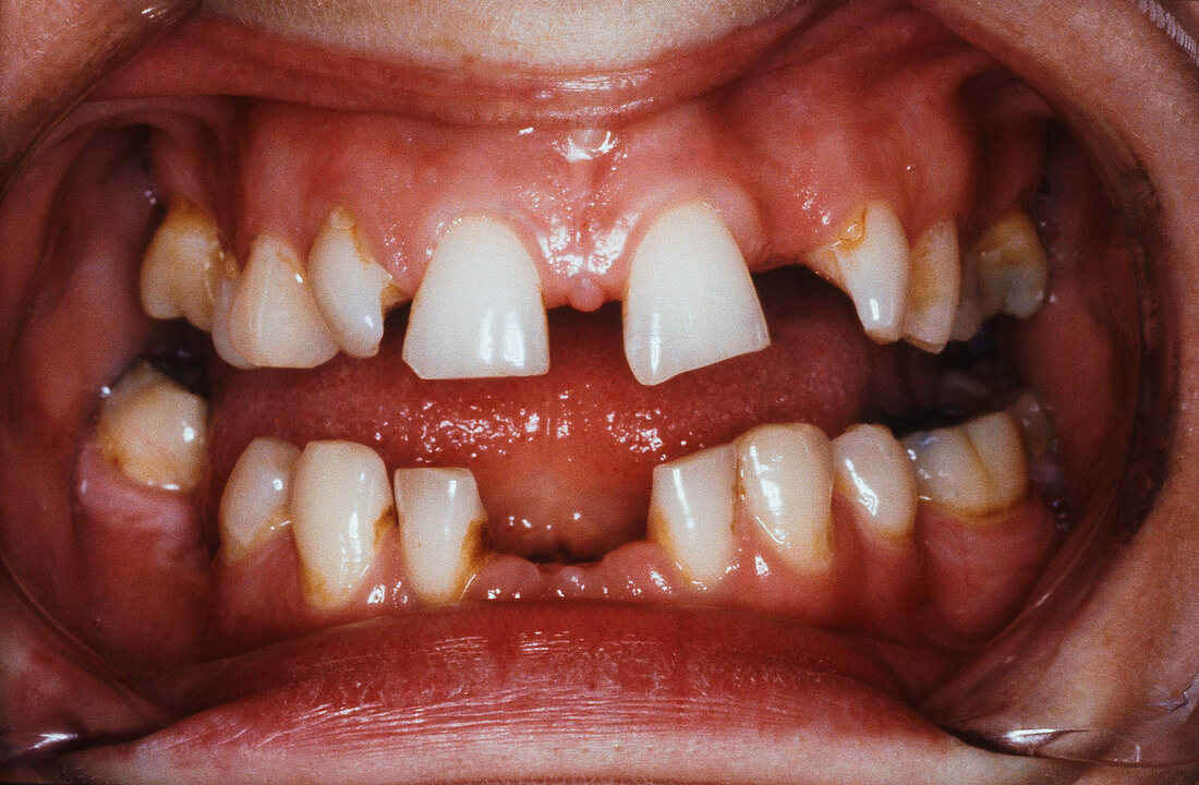 Abnormal teeth spacing