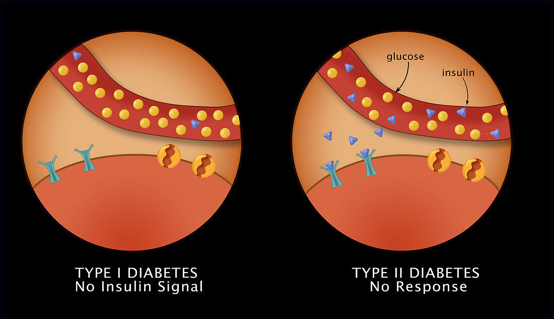 Diabetes I & II,illustration