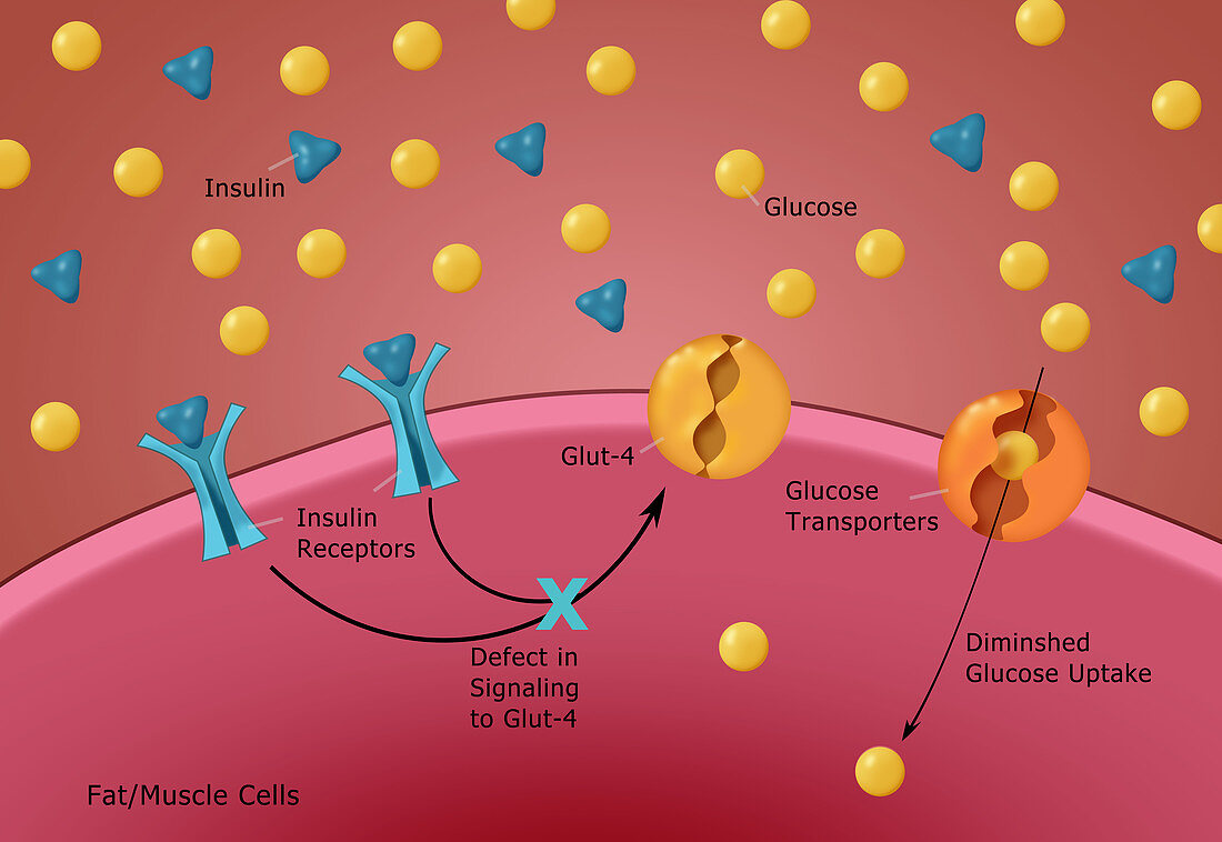 Type II Diabetes,illustration