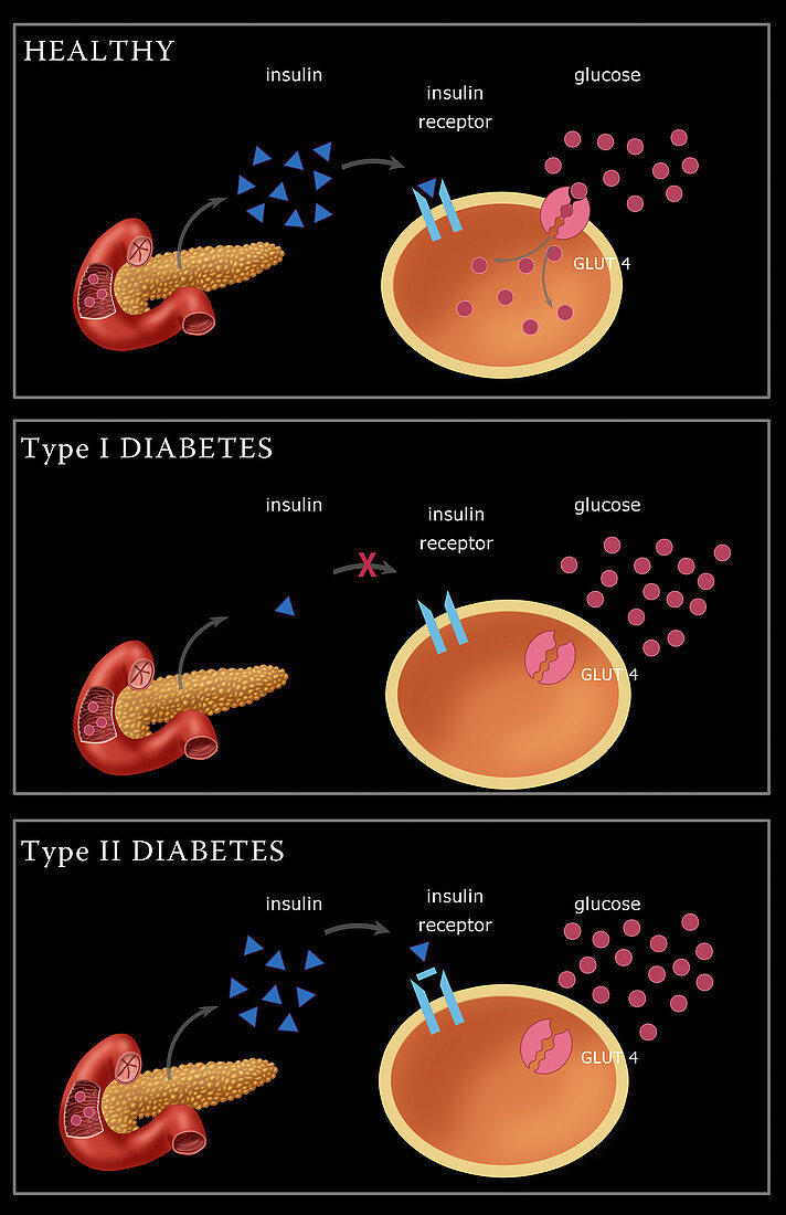 Diabetes I & II,illustration