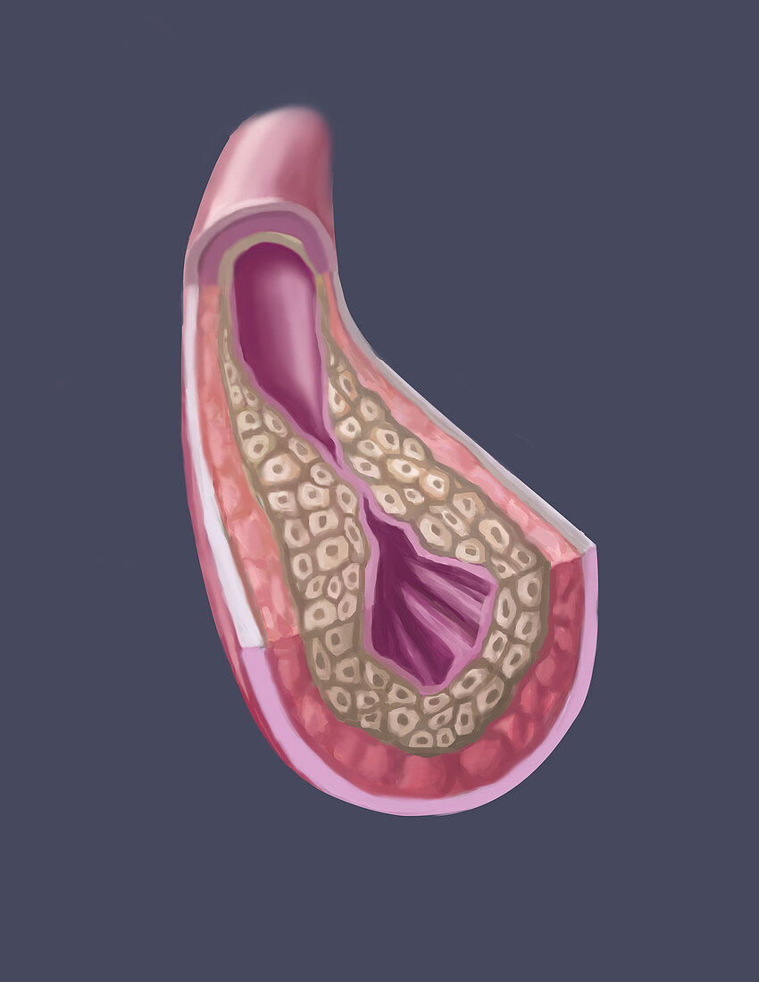 Clogged Artery,illustration