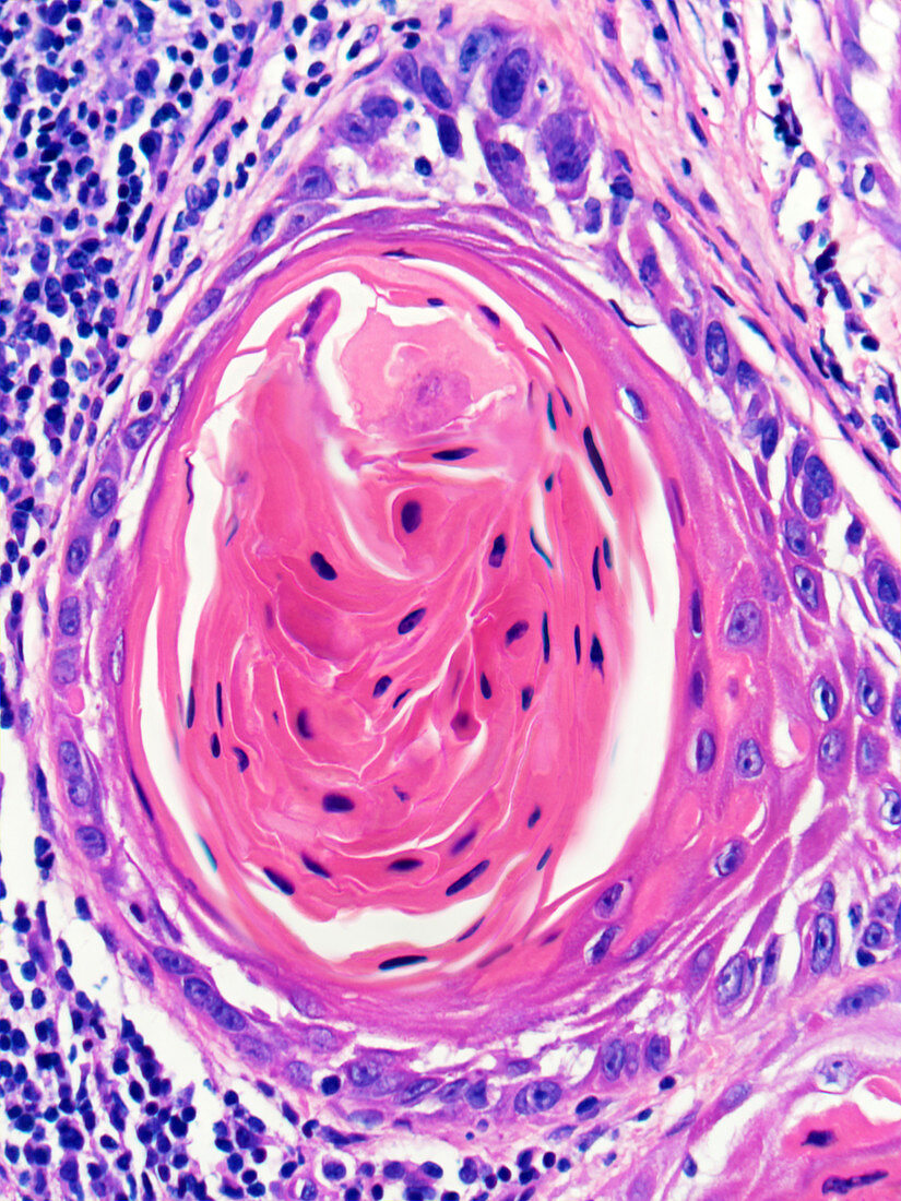Squamous Cell Carcinoma,LM
