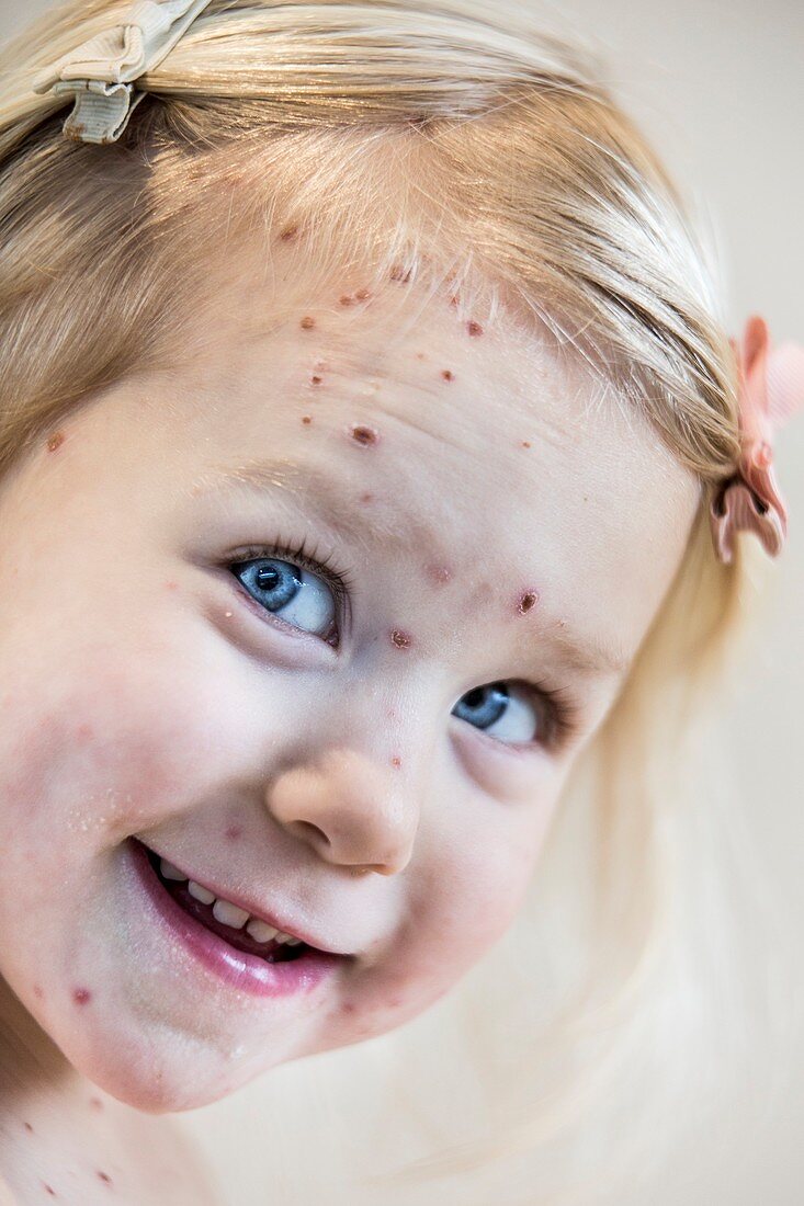 Girl with chickenpox