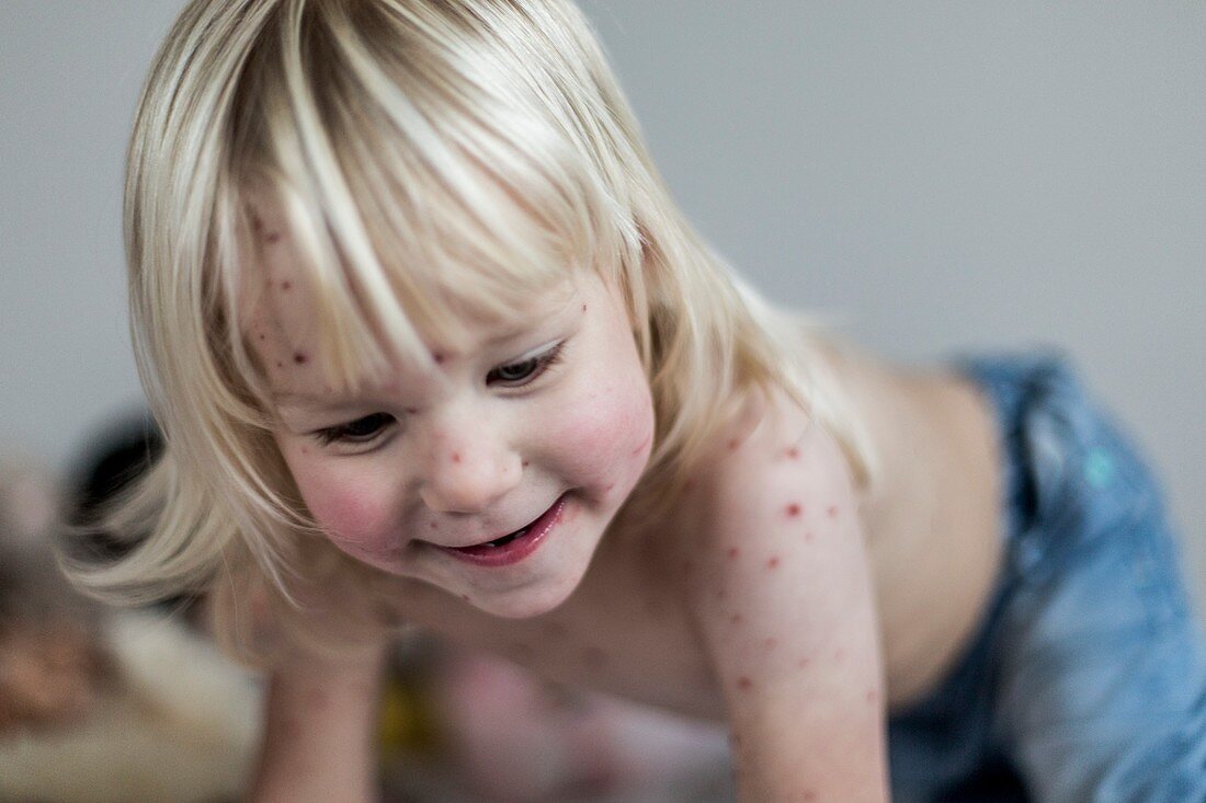 Girl with chickenpox