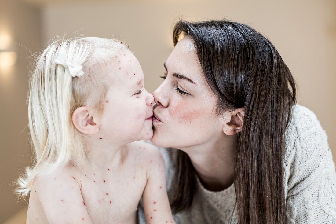 Mother and daughter with chickenpox