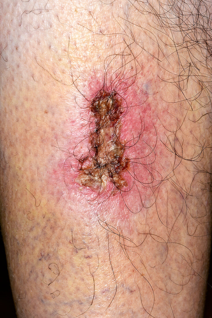 Ulcerated leg wound