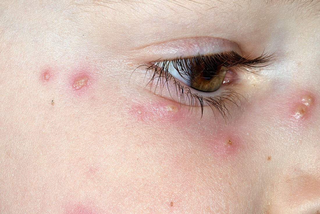 Chickenpox rash