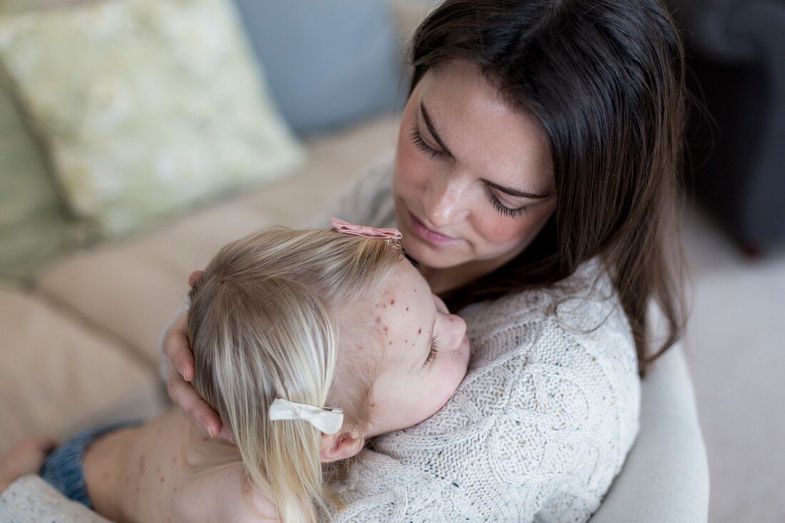 Mother and daughter with chickenpox