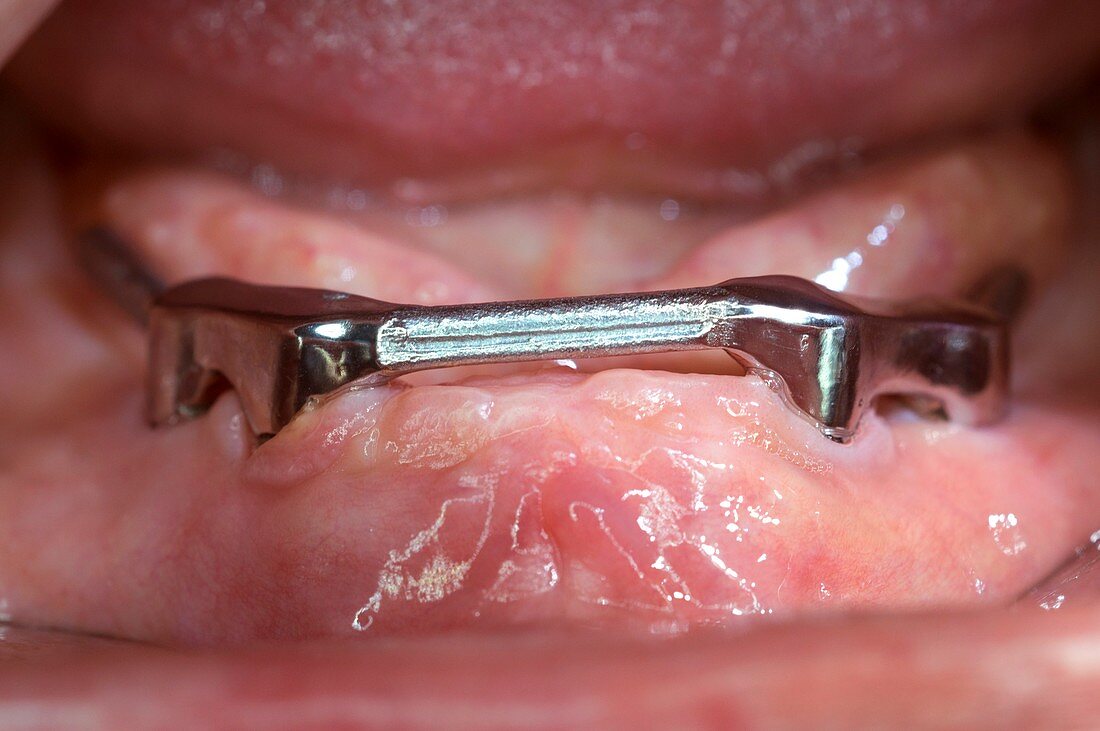 Bar retainer for a denture