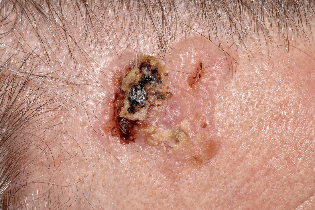 Basal-cell carcinoma skin cancer