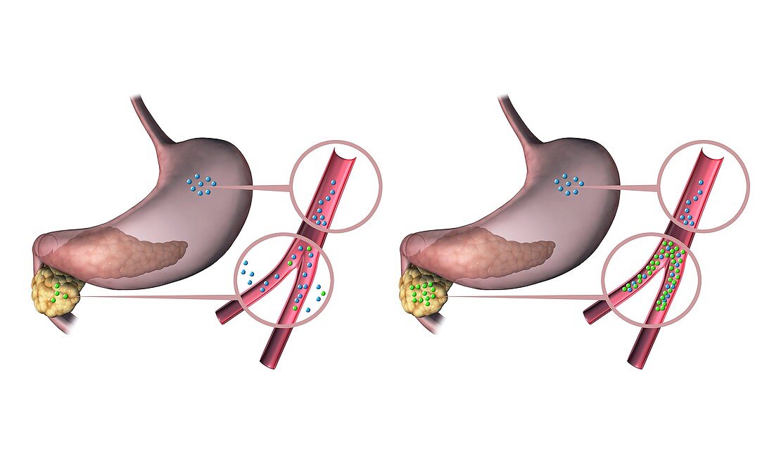 Type 1 and 2 diabetes,illustration