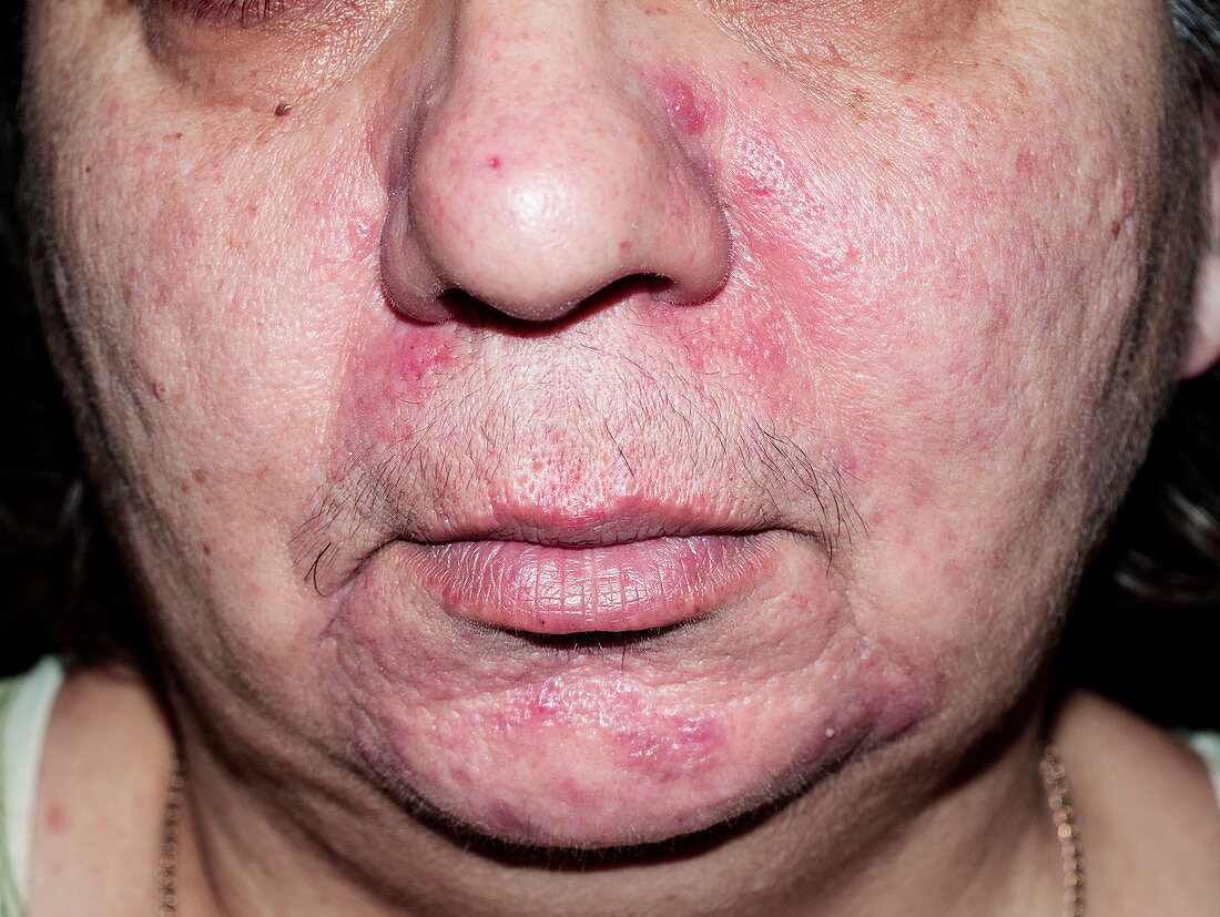 Acne rosacea during treatment