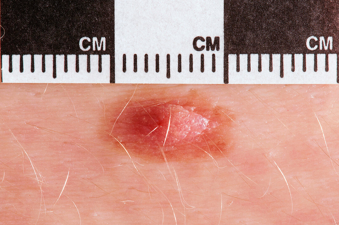 Mole,dermatoscope image
