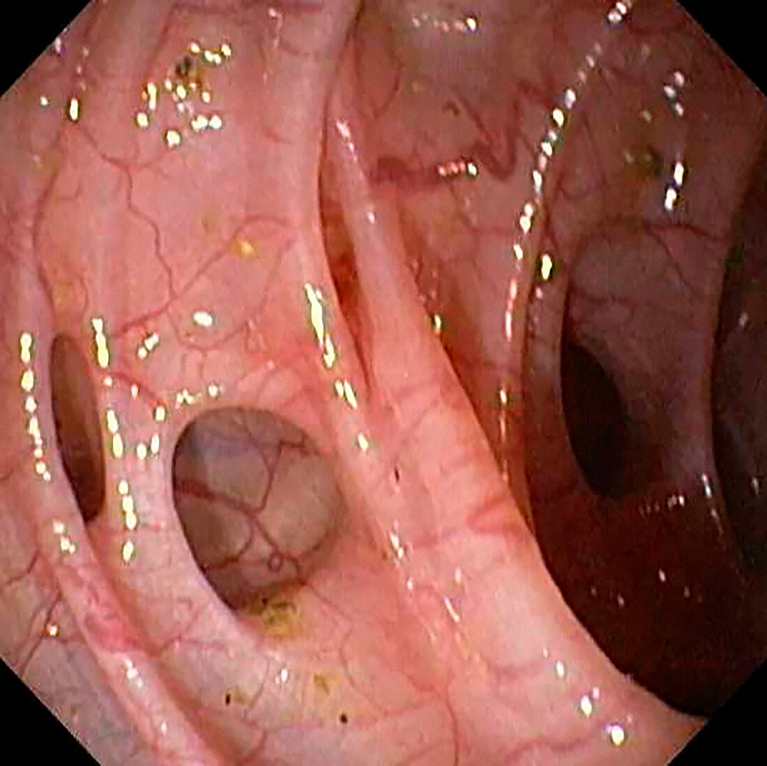 Diverticular disease in the colon